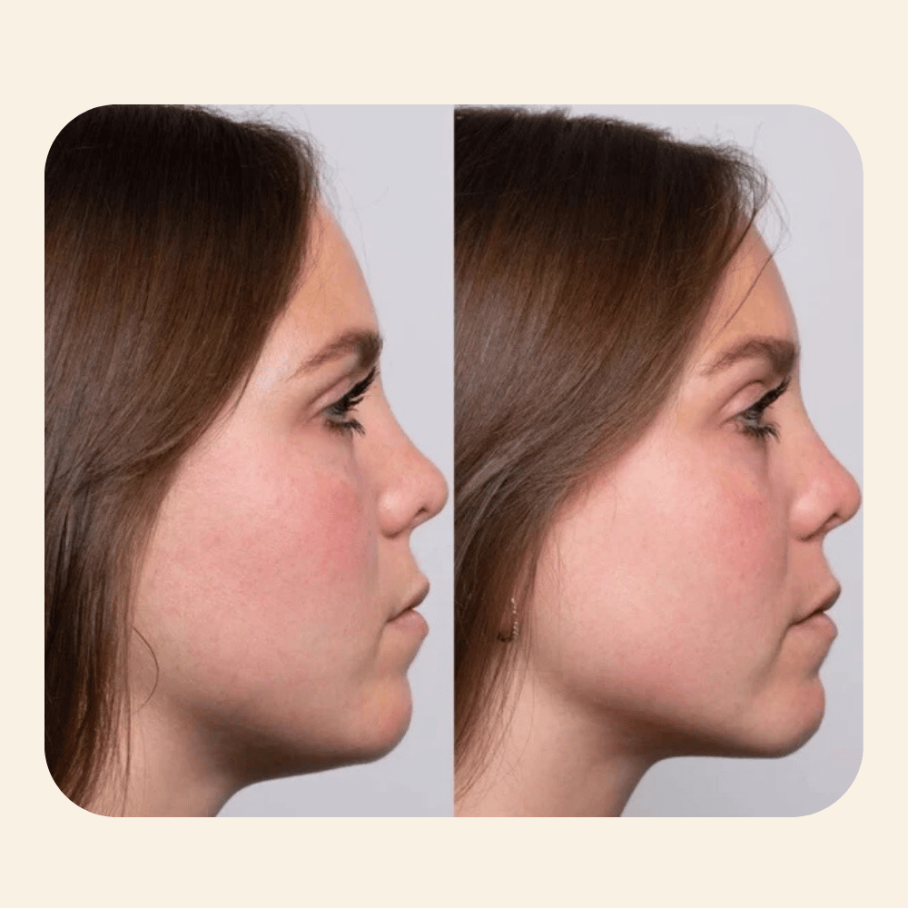 Ansiktsformingsverktøy med rødt lys 2.0