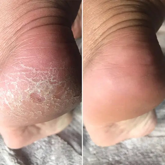 C'est elektrisk fotcallusfjerner PRO