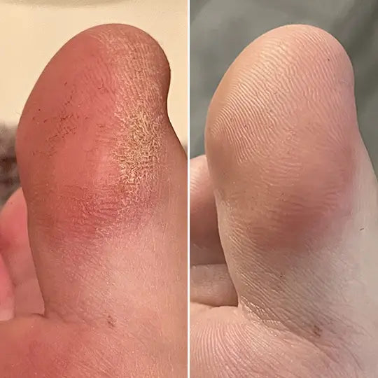 C'est elektrisk fotcallusfjerner PRO